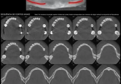 036894_2_2 - mandibula total - axiais_01_tomo.JPG