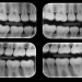 Radiografias Interproximais