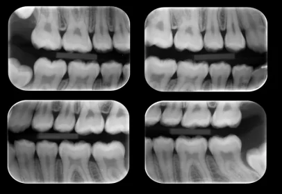 Radiografias Interproximais