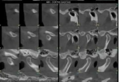 Tomografia Cone Beam da ATM (2).JPG