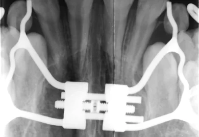 oclusal de maxila